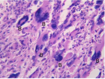 Fig 4Glioblastoma multiforme with multinucleated giant cells and bizarre forms (B) (H&E X400).