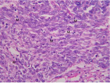 Fig 5Glioblastoma multiforme with numerous mitotic figures (M) (H&E X400).