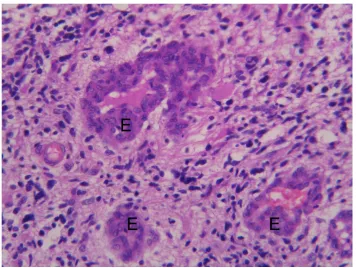 Fig 6Vascular (endothelial)  proliferation(E) in glioblastoma multiforme (H&E X400).
