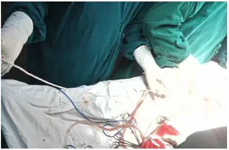Figure 1: Placing of the pack in saphenous space post stripping. 