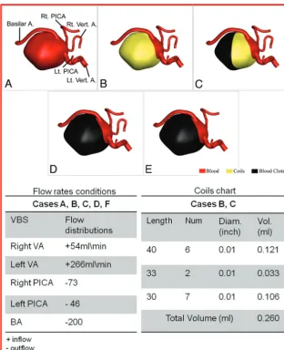 FIG 2. Numeric models of the VBJ GA. A, Outset GA with blood ﬂow (red area). B–C, Endovas-cular treatment, Part 1