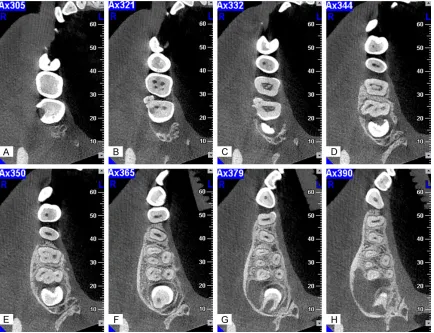 Figure 1. Plane of coronal CBCT section of maxillary right second molar. A and B. Showed different sections on coronal plane of maxillary right second molar, and the supernumerary tooth is on the buccal aspect, the periodontal ligament space was intact around teeth and there existed no periapical pathosis.
