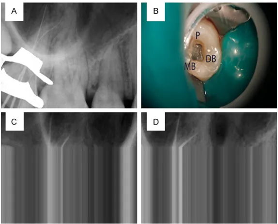Figure 3. Pre-operation images. (A) (Clinical occlusal) and (B) (buccal) showed the view of maxillary second molar and supernumerary tooth after the removal of the temporary restoration