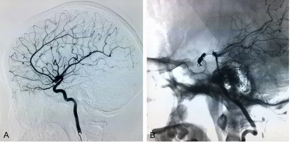 Figure 3. Angiograms at 3 months after the operative. A. Left internal carotid artery angiography reveals the disappearance of the pseudoaneurysm and cavernous sinus fistula