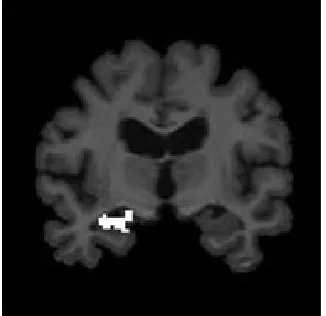 Fig.11: Highlighted Right Hippocampus