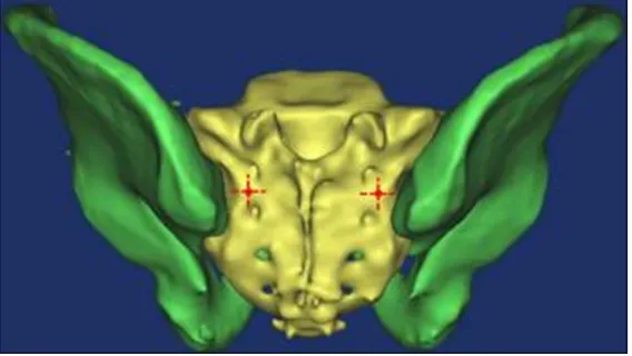 Figure 1. Entry points (red point) of S2AI screws were chosen at the cross point of the lateral sacral crest and the midline between the S1 and S2 dor-sal foramen in a three-dimensional pelvic reconstruction model.