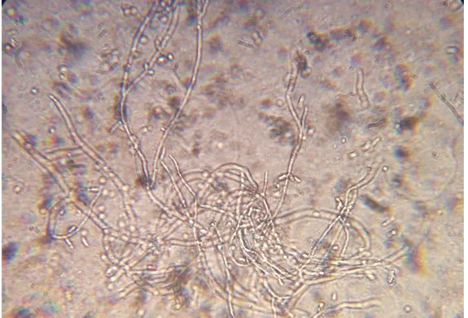 Fig.4 WHITISH PLAQUES AND FISSURES OVER THE GLANS AND PREPUCE DUE TO CANDIDIASIS