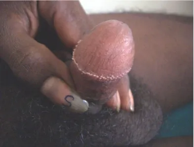 Fig.6  MULTIPLE SEBACEOUS CYST OF THE SCROTUM