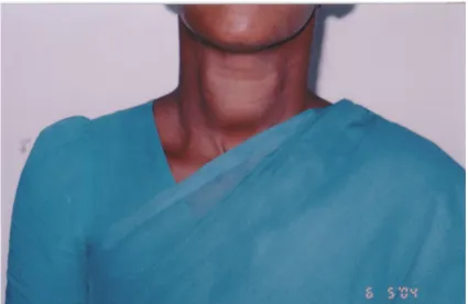 Fig 2: A case of multinodular Goitre
