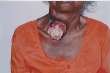 Fig 4: A case of Anaplastic Carcinoma with Ulceration
