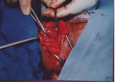 Fig 5: Total thyroidectomy on progress. Recurrent laryngeal nerve shown 