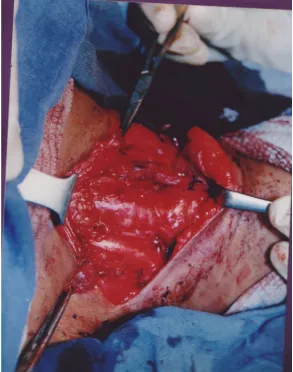 Fig 6: After completion of total thyroidectomy