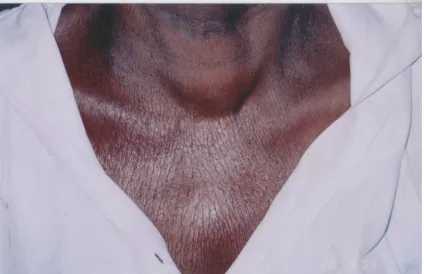 Fig 7(a): A case of anaplastic carcinoma of thyroid who underwent 
