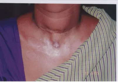 Fig 9: A case of Multinodular goiter who underwent sub 