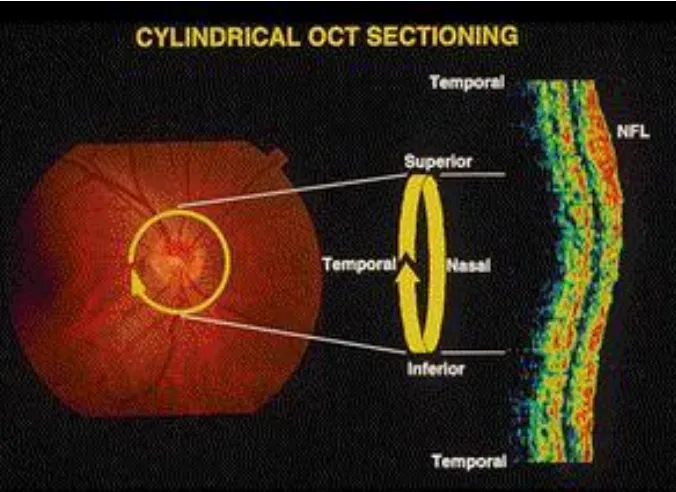 Figure  4 : Optic Nerve Head Evaluation by OCT