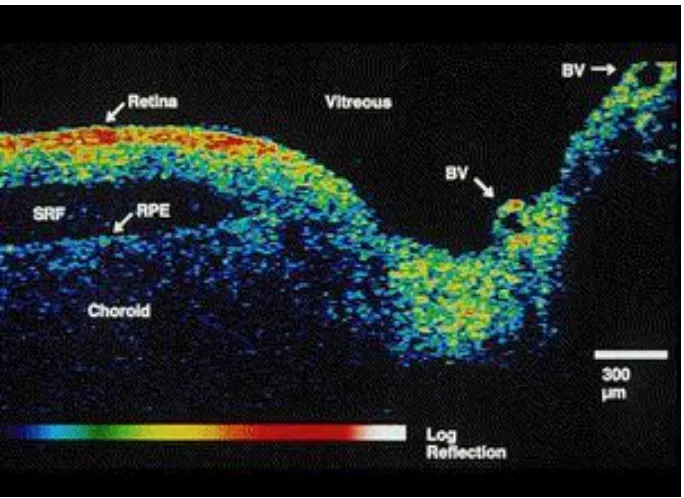 Figure 5 : Optic Nerve Head Cross Section