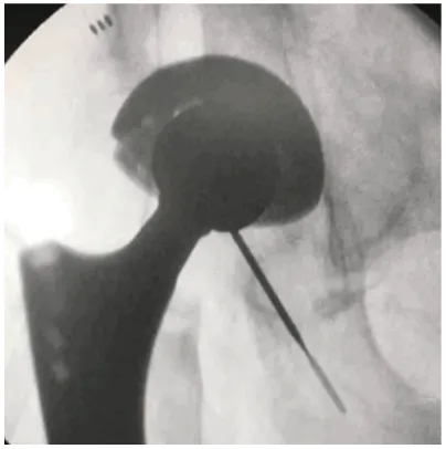 Figure 5. Intra-operative photographs. A: After open-ing the tensor fascia lata, part of the gluteus medius and lateral femoral muscles was excised