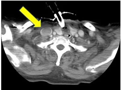 Figure 1. Contrast-enhanced computed tomogra-phy scan performed 71 h postoperatively revealed a poorly contrasted area in the right internal jugular vein (IJV), and IJV thrombus was radiologically diag-nosed.