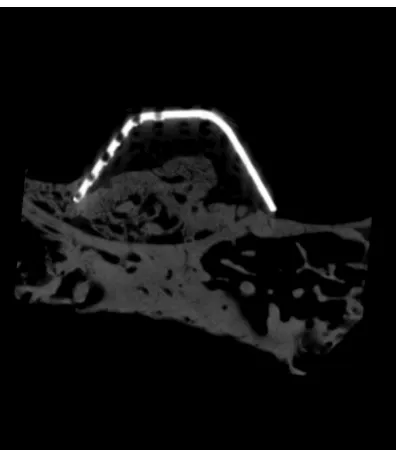 Figure 2. Surgical procedure for maxillary sinus floor elevation after ligating the infraorbital neurovascular bundle.