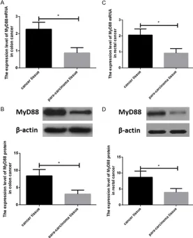 Figure 2. Expression levels of MyD88 in colorectal cancer. A: Expression level of MyD88 mRNA in colon cancer tissues