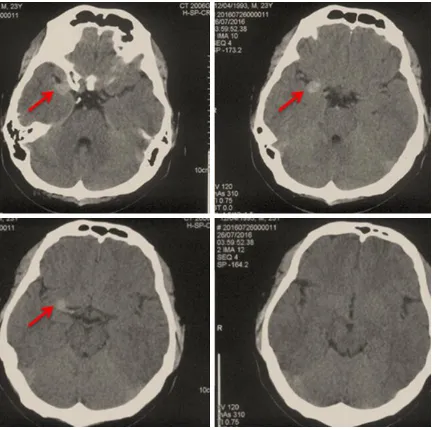 Figure 1. Preoperative CT scan of the head. The hyperdense round-shaped lesion in the lateral fissure was not complicated with a subarachnoid hemorrhage