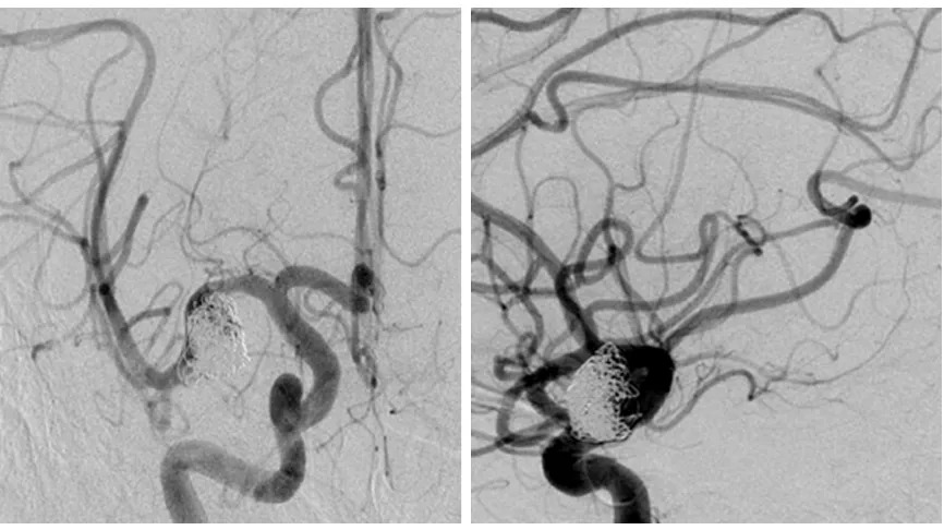 Figure 2. Preoperative DSA of the head. The red arrow indicates a dissecting AN located in the right M1 segment of the MCA.