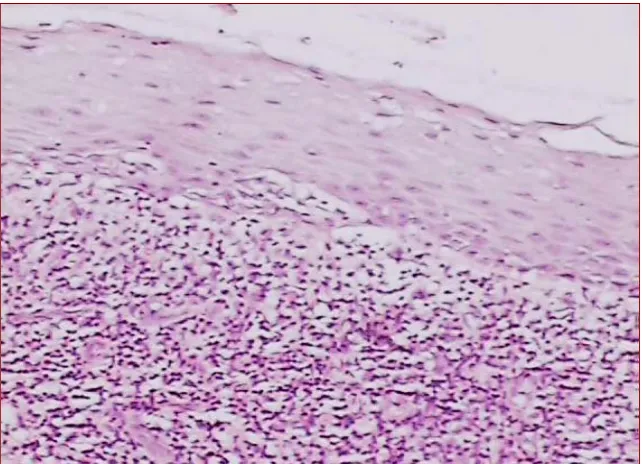 Figure 3 Photomicrograph of Lichen Planus H&E (10x)    