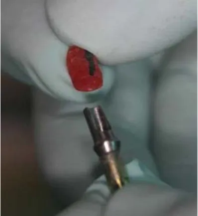 Table 2: Comparison of the mean spatial position in 4 positionsbetween the two implants impression techniques (OT, AP)