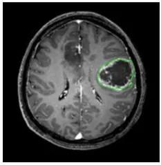 Figure 1.1 : 2D MRI brain image with edge detection 