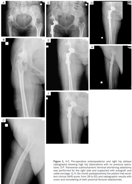 Figure 1. A-C. Pre-operative anteroposterior and right hip oblique radiographs showing high hip dislocations with no previous opera-tions