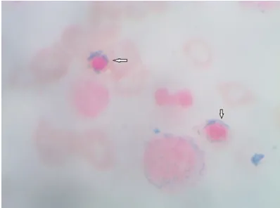 Figure 2. Ring sideroblasts. Bone marrow, Perls’ staining, 100×.