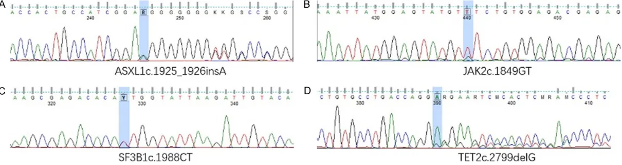 Figure 5. Next-generation sequencing: four mutations in BM sample. A: A frameshift mutation in ASXL1 gene: c.1925_1926insA (p.Gly643ArgfsTer15); B: A missense mutation in JAK2 gene: c.1849G>T; C: A missense mutation in SF3B1 gene: c.1988C>T; D: A frameshift mutation in TET2 gene: c.2799delG (p.Gly934GlufsTer19).