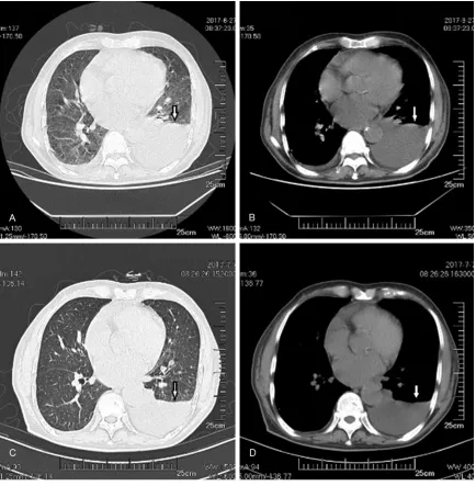 Figure 6. Computed tomography (CT) of the chest in June 2017 at the first hospitalization