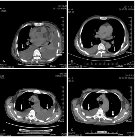 Figure 7. Mediastinal window of the chest CT scans at the second and third hospitalization