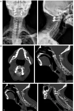 Figure 5. (A, B) Five months after operation, the X-rays of the cervical spine (Aa, Ab) and CT (Ba, Bb) showed good internal fixation and bone callus was observed at the bone graft site.