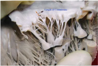 Fig. 15:  Mitral annulus measurement.  