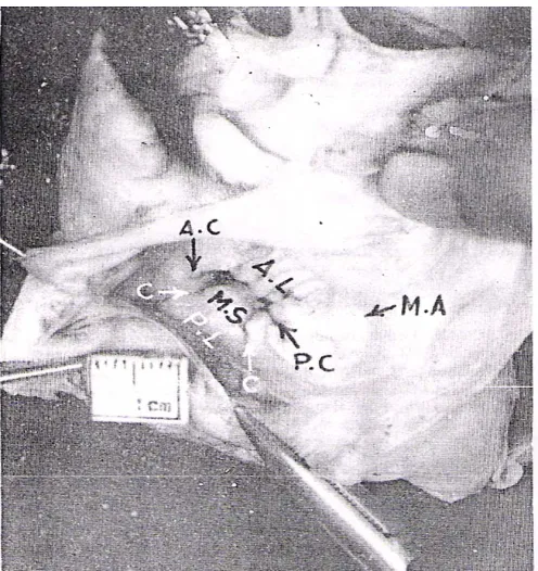 Fig. 5(b): Left atrial view of the mitral valve in the age group of 21 – 40 yrs. A.L  = Anterior leaflet; P.L