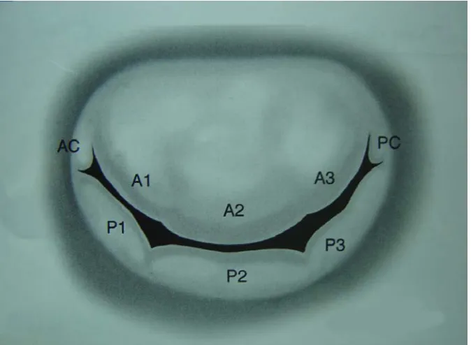 Fig.5(c): Left atrial view of the mitral valve in the age group of above 40 yrs. A.L = Anterior leaflet; P.L