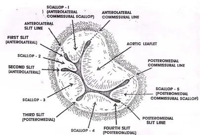 Fig. 7(b): Varied configuration of the commissural chordae.    