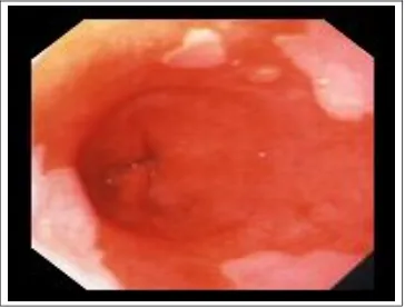 Fig 3 Endoscopic appearance of Gastroesophageal  junction –red columnar mucosa            with pink squamous mucosa –dentate or Z line