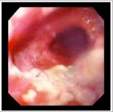 Fig 5 Endoscopic appearance of Carcinoma esophagus-irregular obstructive growth            with menisci sign