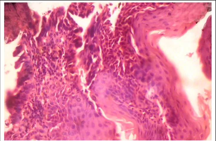 Fig 7 Adenocarcinoma arising from Barrett’s esophagus –glandular and tubular           profiles, lined by columnar cells
