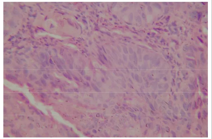 Fig 9 Well differentiated squamous cell carcinoma – Keratin pearl formation.Biopsy            (H & E X 100)