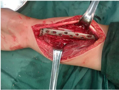 Figure 4. Pictures of surgical procedure. Implant iliac crest.