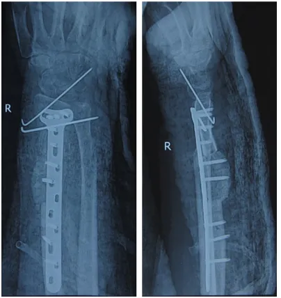 Figure 7. The typical pre- and post-operative X-ray representation of GCT of the distal radius