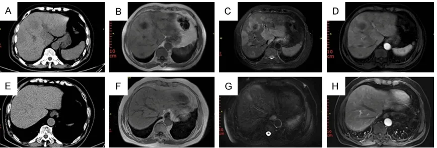 Figure 1. Before chemotherapy: (A) Plain abdominal CT showing multiple hypodense areas in the liver