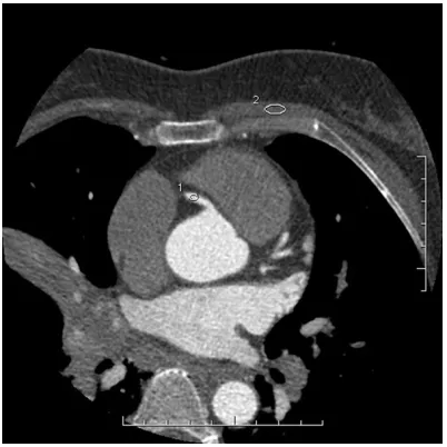 Figure 1. CT values and image noise of RCA using muscle as background, in a male 65 years old and with BMI of 29.2 Kg/m2