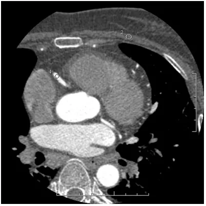 Figure 4. CT values and image noise of RCA using muscle as background, in a male 60 years old and with BMI of 26.4 Kg/m2 (weight group)