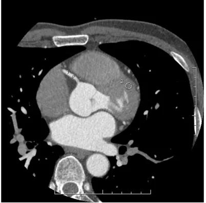 Figure 8. CT values and image noise of RCA of a male 49 years old and BMI of 25.2 Kg/m2 using muscle as background
