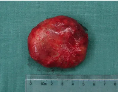 Figure 3. An oval mass on the right side of the oropharynx, the lesions produced slightly abnormal signals, and the STIR phase produced a mostly mixed signal with high signal, measuring approximately 7.0 × 5.5 × 4.0 cm.